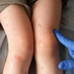 Ecuador, sin casos de sarampión, activa protocolos de vigilancia tras alerta en Perú